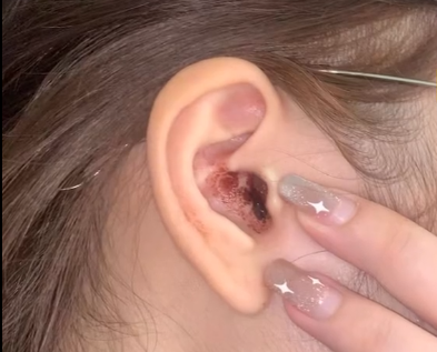 警惕！19岁女生戴耳机睡觉致耳朵流血流脓