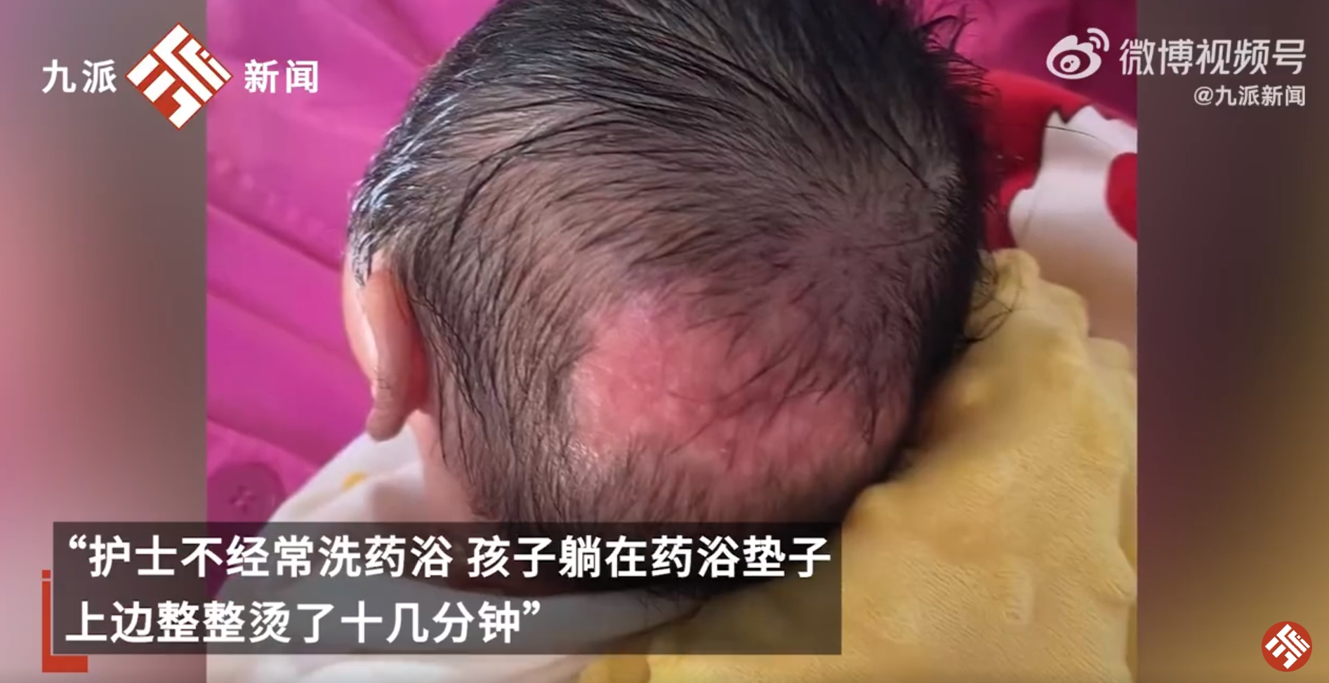 新生儿被护士烫伤致后脑勺大片水肿